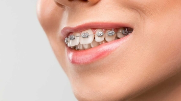 Orthodontic treatment