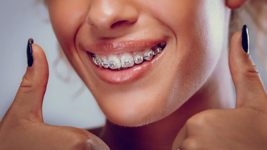 Close-view-of-smiling-woman-with-braces-on-teeth-1024x683